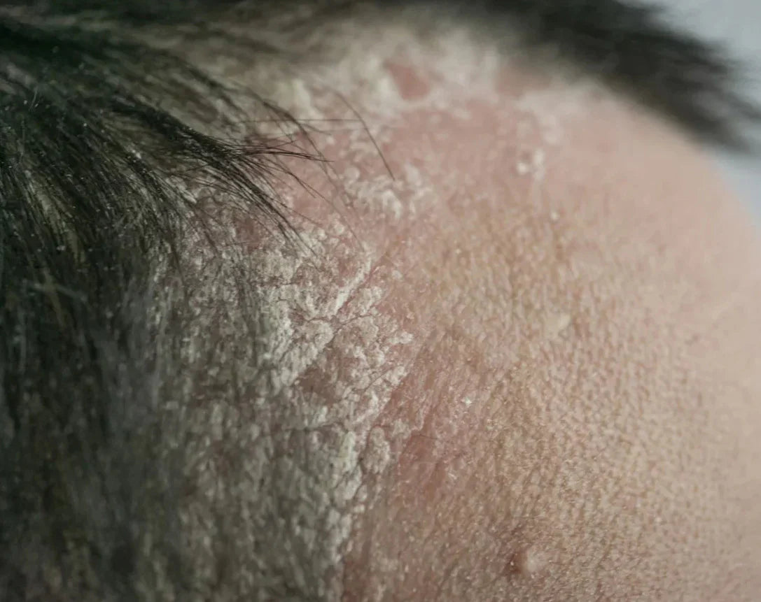Dry Scalp