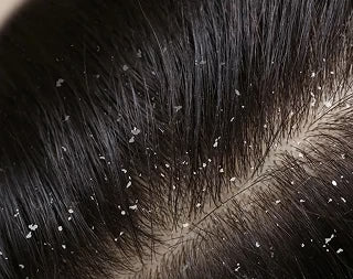 Dandruff And Scalp Itchiness  Dry Scalp